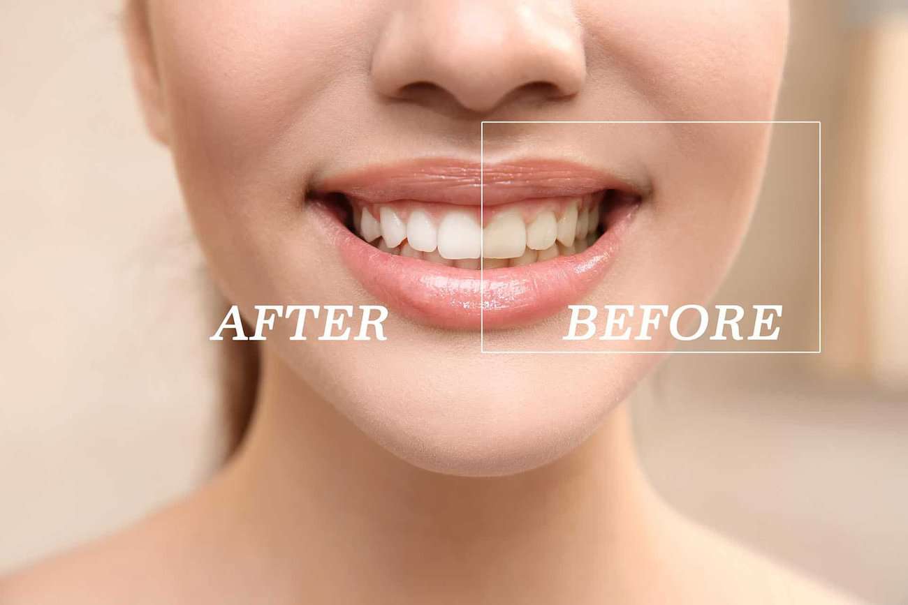 What Are the Most Effective Natural Teeth Whitening Methods You Can Try Chester?