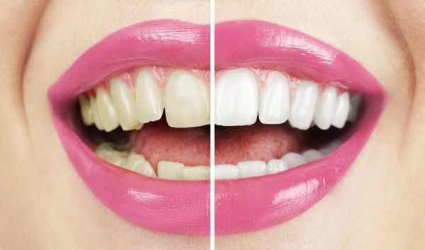 What Makes Ultima White Teeth Whitening Different Chester
