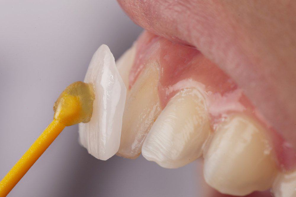 Dental Veneers: Achieving a Flawless Look Chester