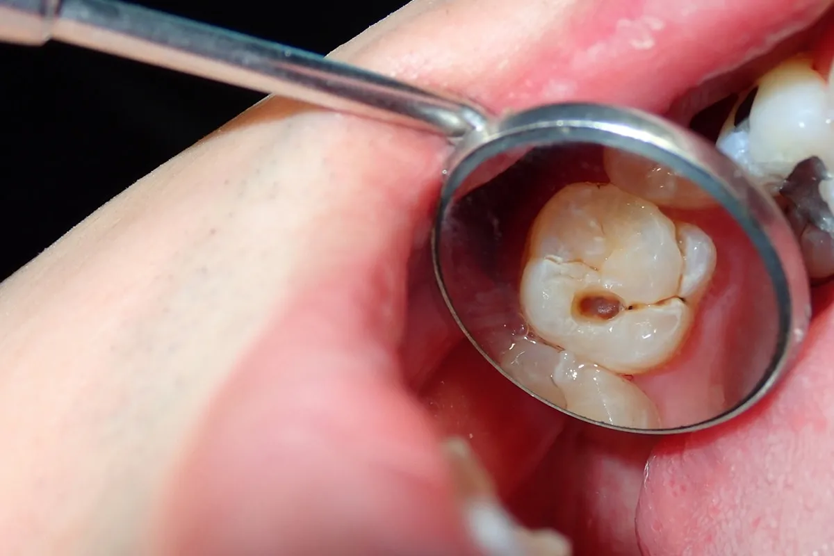 Why Do Teeth Crack? Common Causes to Know Chester