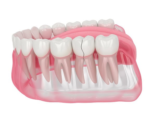 How Can You Manage Pain and Discomfort After a Root Canal Chester?