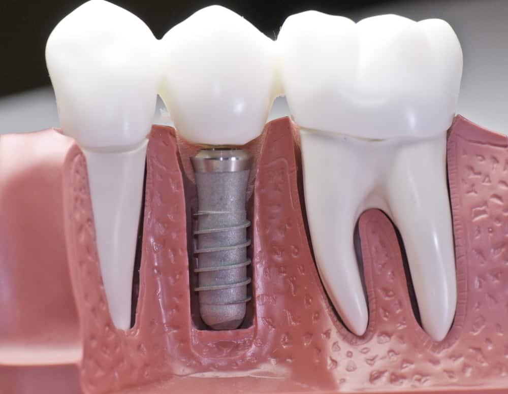 Who Is a Good Candidate for Dental Implants Chester?