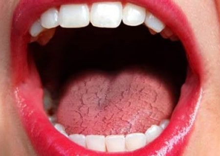 Common Causes of Dry Mouth (Xerostomia) Chester