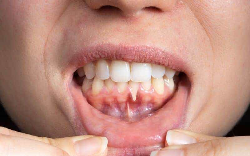 How Can Gum Disease Be Prevented Chester?