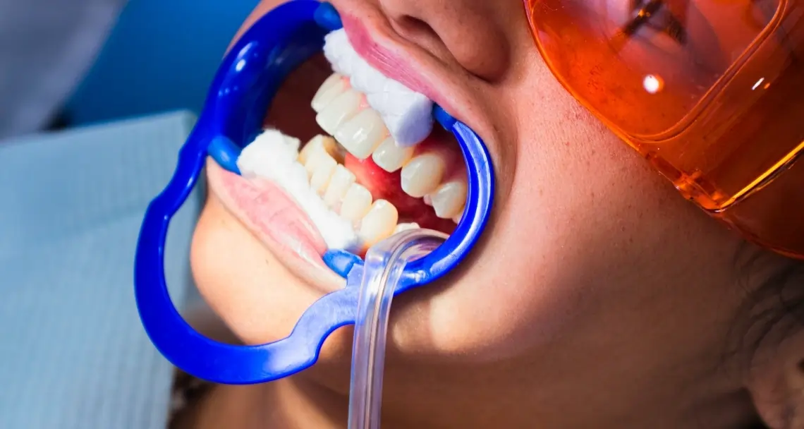 How Teeth Whitening Treatments Actually Work on Your Enamel Chester