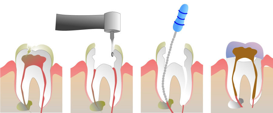 How Do You Properly Care for Your Teeth After a Root Canal Chester