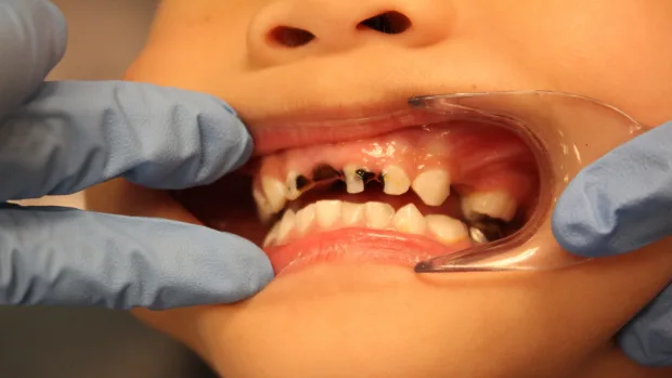 Which Foods and Drinks Cause the Most Damage to Young Smiles Chester?