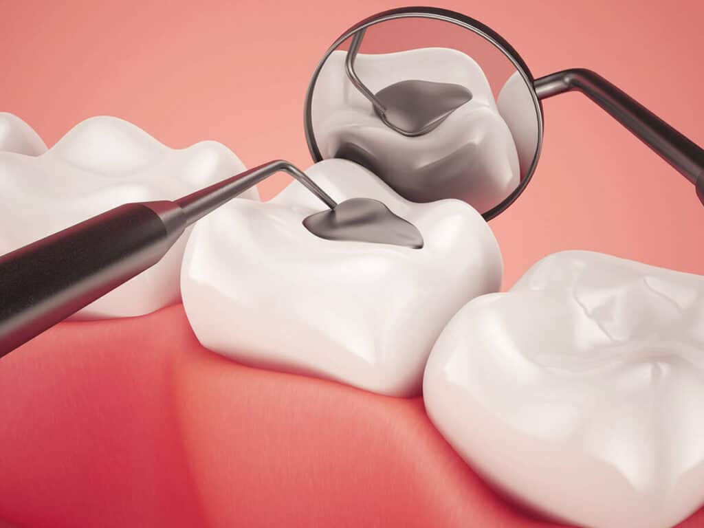 Fighting Cavities and Plaque Buildup Chester