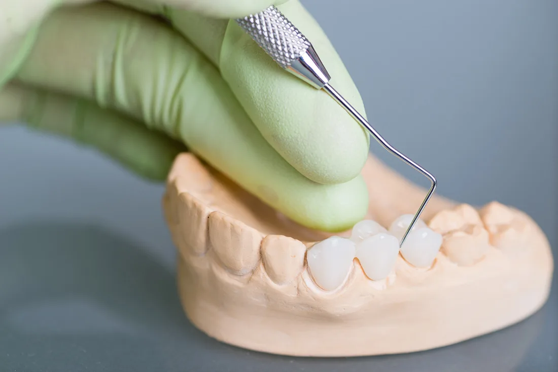 What Are the Different Types of Dental Crowns Available Chester?