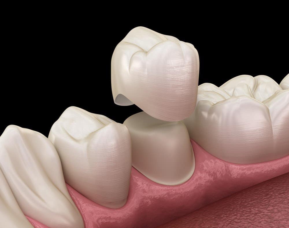 What is the Procedure for Getting Dental Implants Chester?