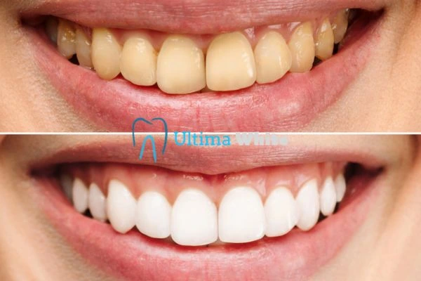 Why Might Multiple Whitening Sessions Be Necessary Chester?