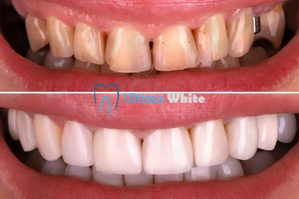 What Makes Instant Teeth Whitening Treatments So Popular Chester?