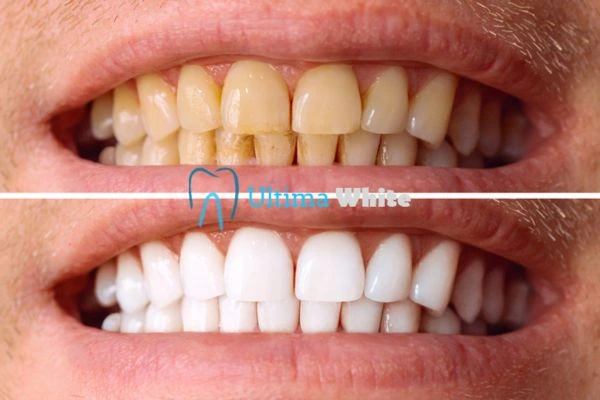 Stained Teeth and Persistent Bad Breath Chester
