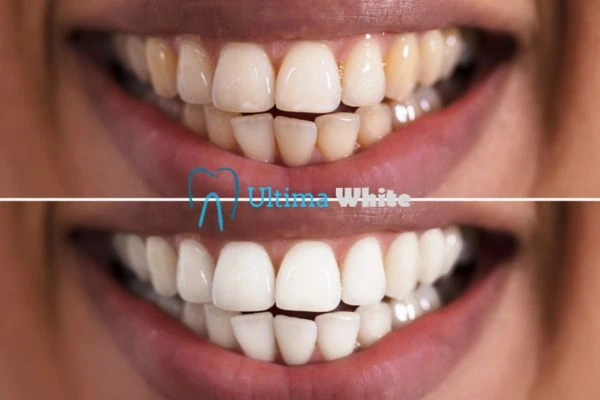 Aftercare Tips to Maintain Your New Smile Chester